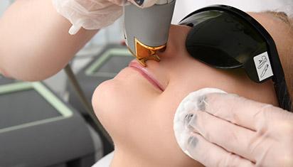 Epilation lèvre, duvet, Levallois-Perret Epilation lèvre, duvet, Levallois-Perret